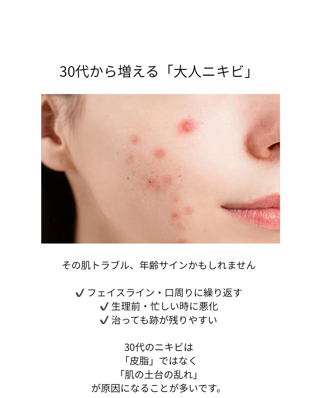 30代から増えるニキビの正体👇