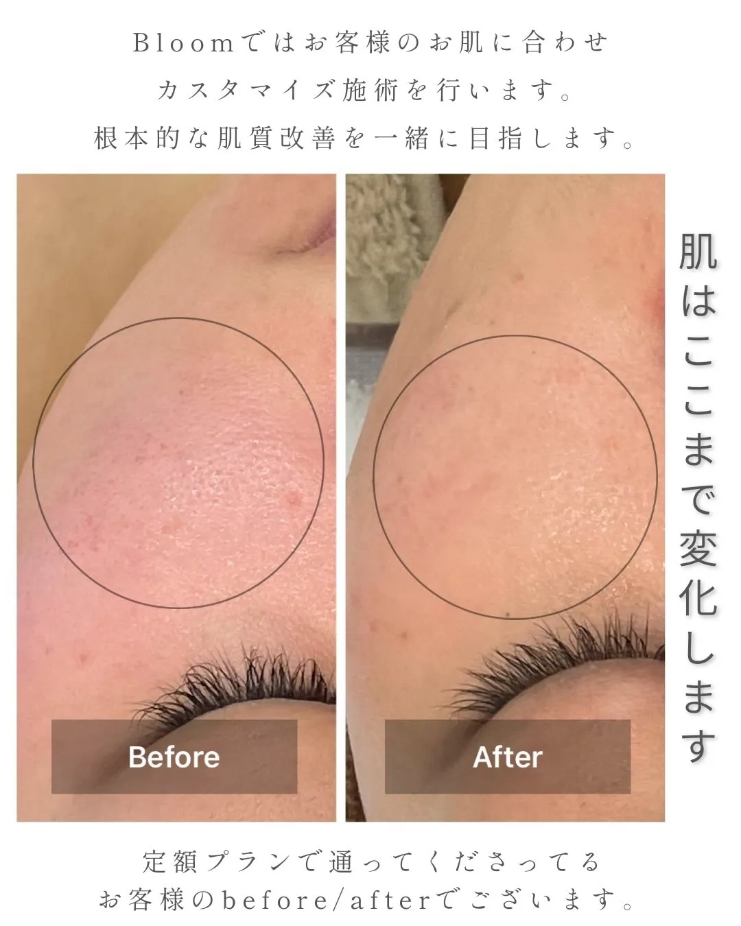 Bloomではお客様のお肌に合わせてカスタマイズ施術を行いま...